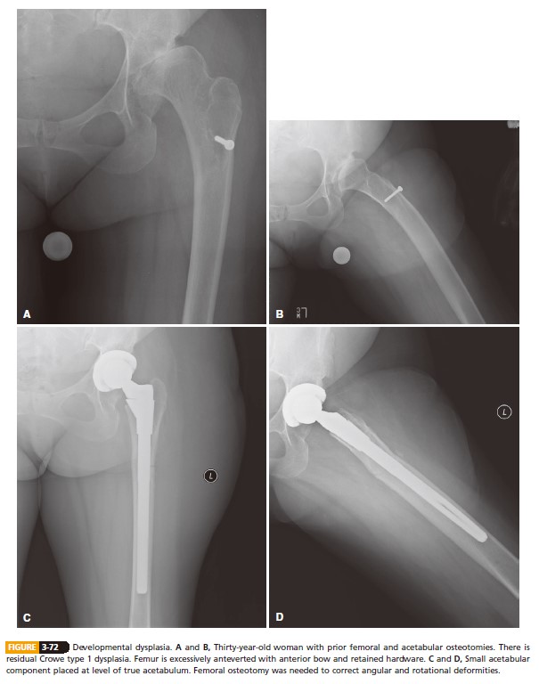 DEVELOPMENTAL DYSPLASIA