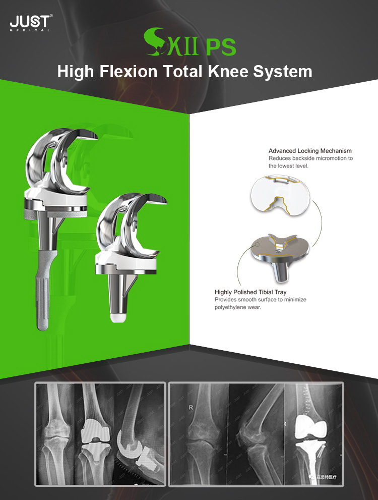 SKII® PS High Flexion Total Knee System