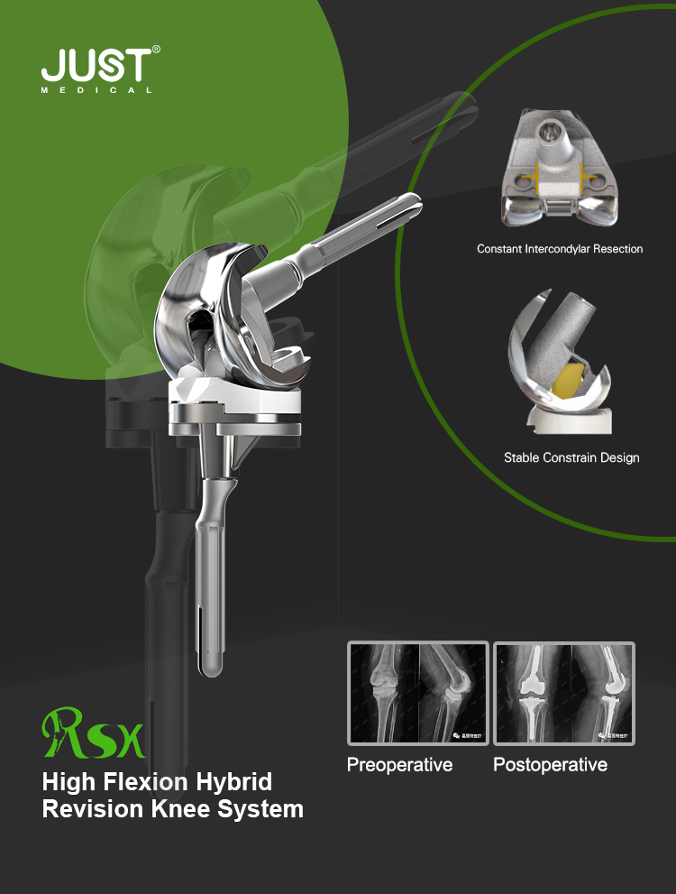 Case Sharing——JUST RSK Total Knee Revision Surgery