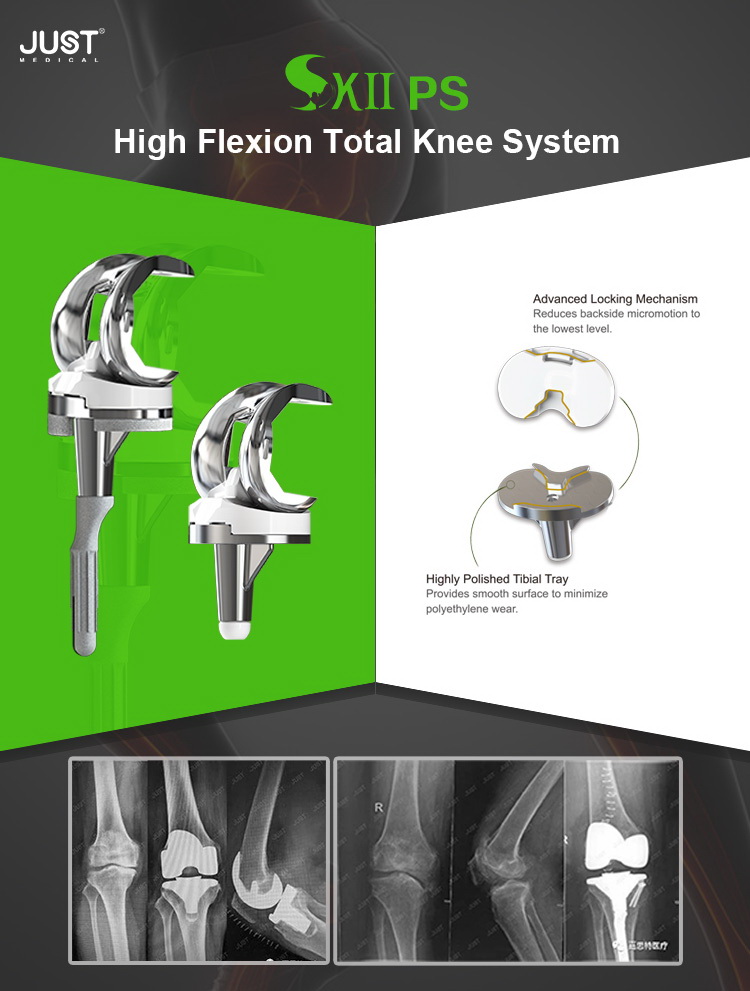 SKII® PS High Flexion Total Knee System 