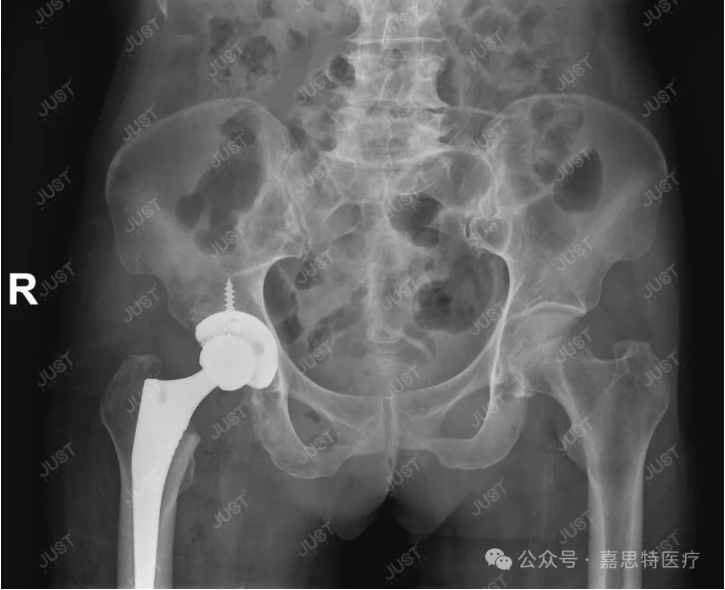 JUST Lateral Decubitus DAA Minimally Invasive Total Hip Replacement Surgery
