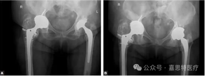 Prosthesis Selection in Hip Revision Surgery: Femoral Prosthesis (Part I)