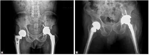 Factors to Consider When Choosing a Surgical Approach for Total Hip Arthroplasty (THA) Revision